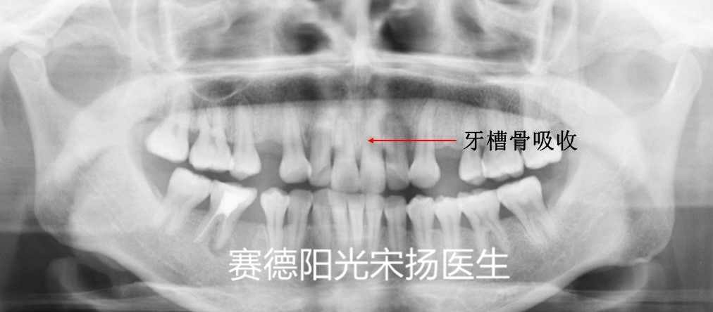 918博天堂阳光口腔宋扬医生牙齿黑三角科普图片