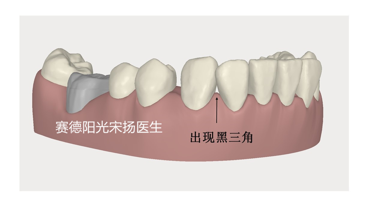 918博天堂阳光口腔宋扬医生牙齿黑三角科普图片