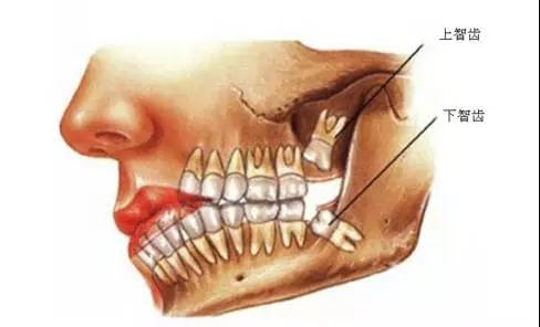 智齿示意图 918博天堂阳光口腔