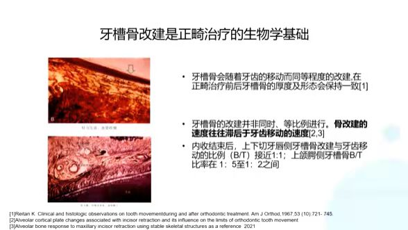 北京万柳分院王思晗医生解读《切牙内收后的牙槽骨改建》的相关文献