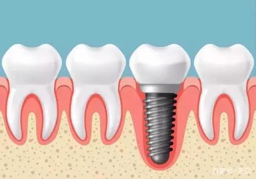 种植牙或种牙，常被人称为是人类的“第三副牙齿”：